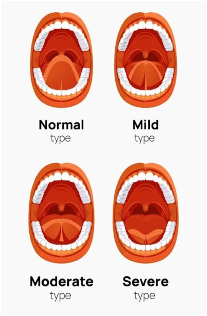 What is mild tongue-tie?