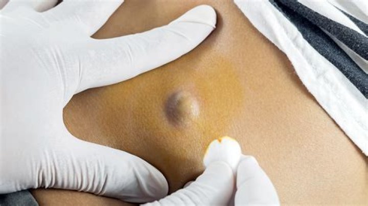 What is the black stuff that comes out of a cyst?