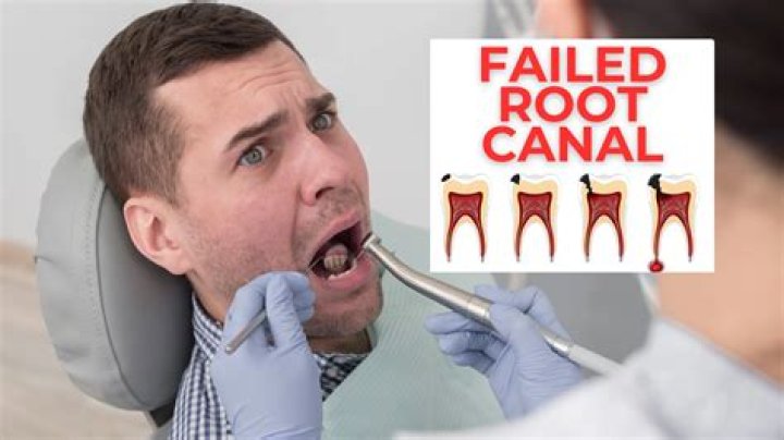 What is the failure rate of root canals?