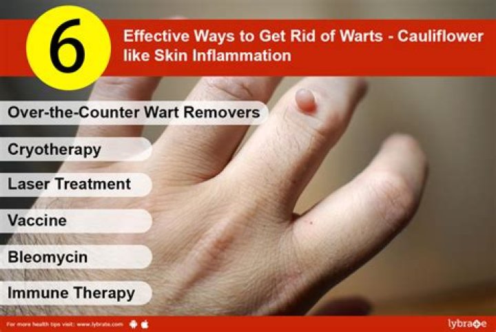 What kills the wart virus?