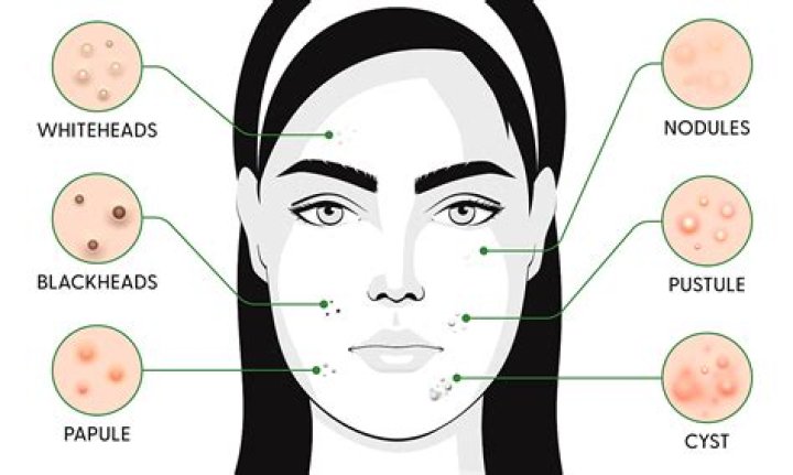 What percent of the world has acne?