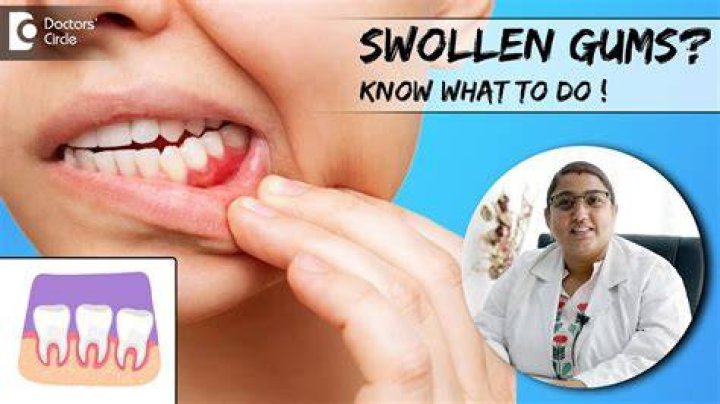 What should you not drink with swollen gums?
