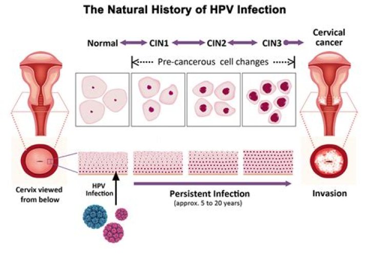 What type of HPV causes CIN 3?