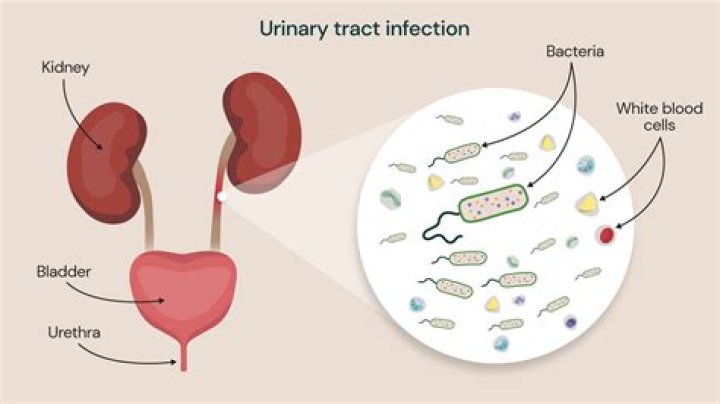 What UTI looks like?