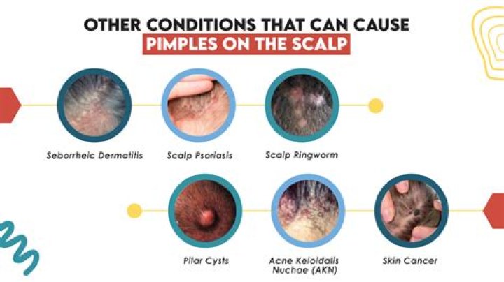 When I pop a pimple something hard comes out?