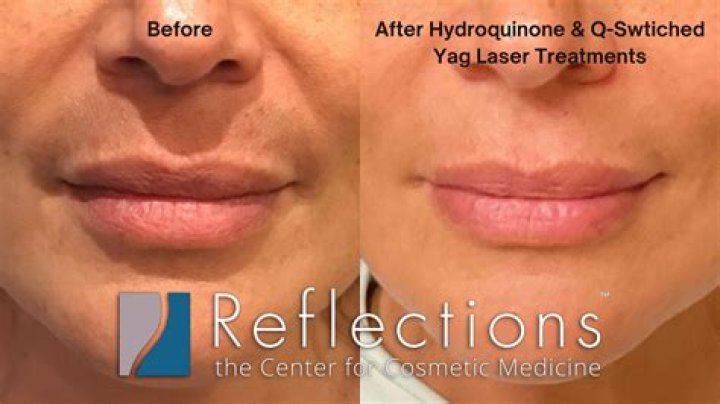 Which laser is best for dark spots?