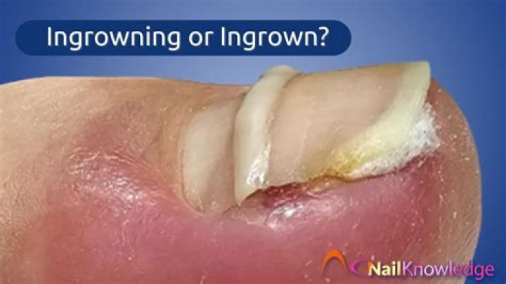 Why do I have a second toenail?