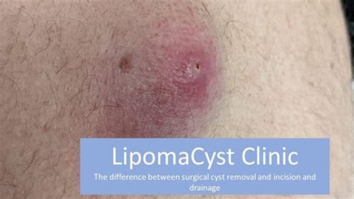 Why does a cyst keep filling up?