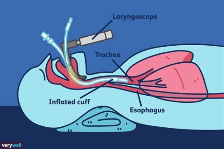 Why does intubation hurt?